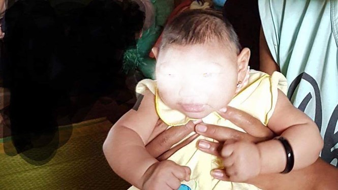 Bé gái 4 tháng tuổi bị đầu nhỏ nghi do vi rút Zika tại Việt Nam /// Ảnh: Thúy Anh