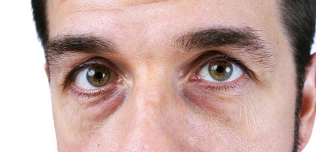 Quầng thâm dưới mắt có thể là triệu chứng dễ nhận thấy của bệnh dị ứng thời tiết.